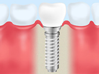 周りの歯を傷つけずに治療ができるインプラント