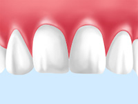 歯の色をもっと白くしたい方へ～ホワイトニングとは～ after